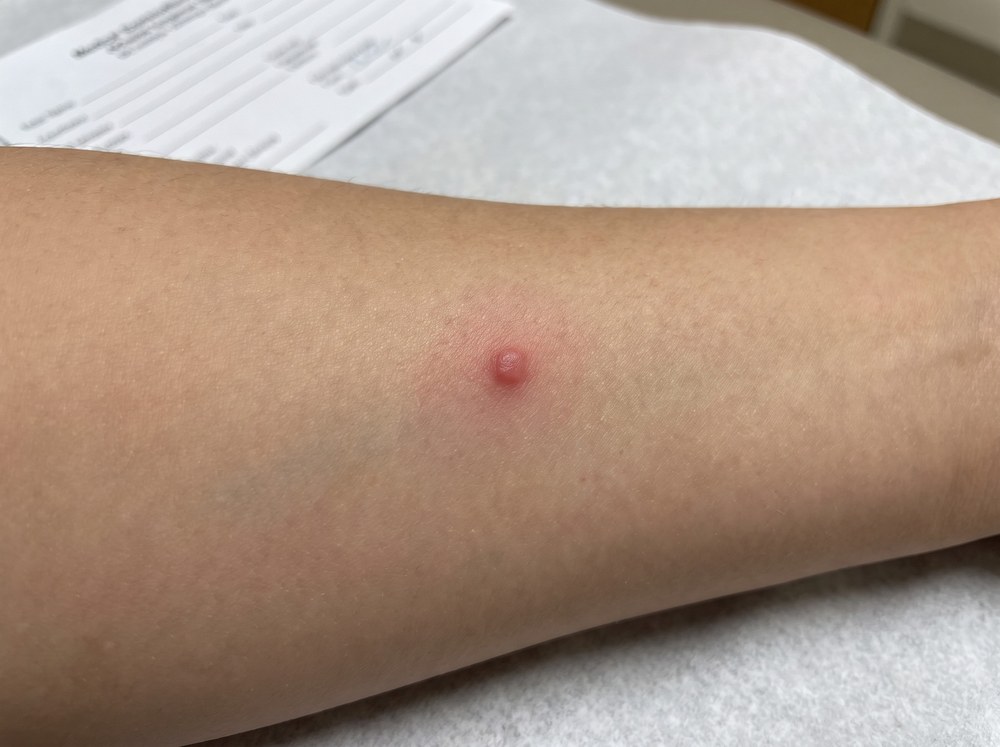 Close-up photo of a fresh giant water bug bite on a bare foot showing a red puncture mark with mild swelling